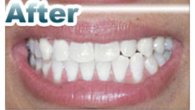 Davinci Teeth Whitening Systems